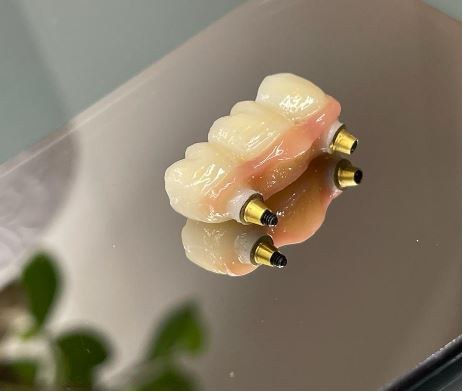 Implant-supported bridge produced in Creadent's in-house laboratory